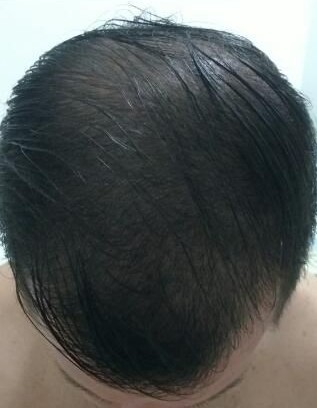 Depois do tratamento