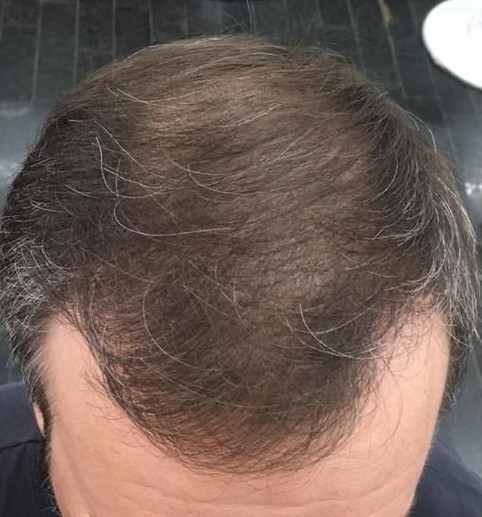 Depois do tratamento